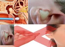Bersihkan Telinga Pakai Cotton Bud Bisa Budeg